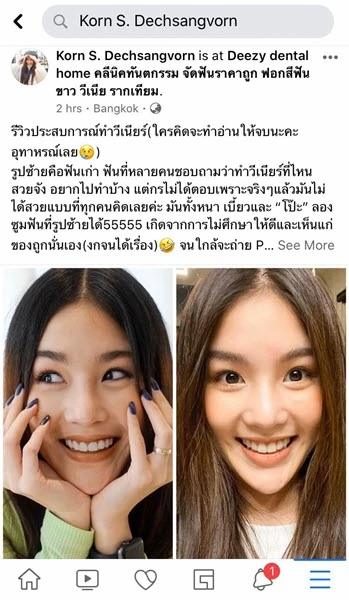 จัดฟันขอนแก่น, จัดฟันอุดรธานี, จัดฟันอุบลราชธานี รีวิว 1 จัดฟันขอนแก่น, จัดฟันอุดรธานี, จัดฟันอุบลราชธานี รีวิว 1