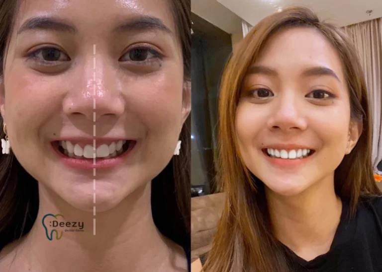 จัดฟันขอนแก่น, จัดฟันอุดรธานี, จัดฟันอุบลราชธานี รีวิว 2 จัดฟันขอนแก่น, จัดฟันอุดรธานี, จัดฟันอุบลราชธานี รีวิว 2