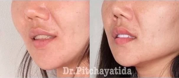 จัดฟันขอนแก่น, จัดฟันอุดรธานี, จัดฟันอุบลราชธานี รีวิว 3 จัดฟันขอนแก่น, จัดฟันอุดรธานี, จัดฟันอุบลราชธานี รีวิว 3