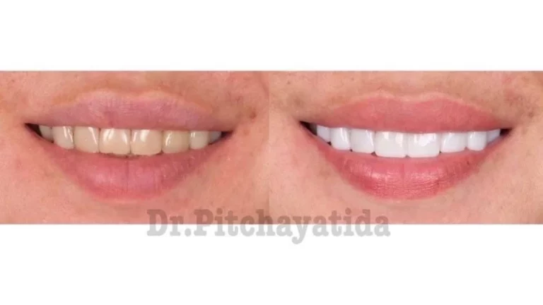 จัดฟันขอนแก่น, จัดฟันอุดรธานี, จัดฟันอุบลราชธานี รีวิว 4 จัดฟันขอนแก่น, จัดฟันอุดรธานี, จัดฟันอุบลราชธานี รีวิว 4