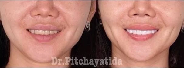 จัดฟันขอนแก่น, จัดฟันอุดรธานี, จัดฟันอุบลราชธานี รีวิว 5 จัดฟันขอนแก่น, จัดฟันอุดรธานี, จัดฟันอุบลราชธานี รีวิว 5