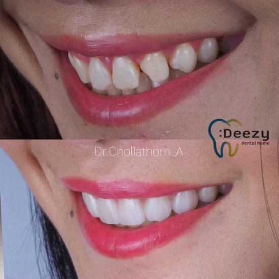 จัดฟันขอนแก่น, จัดฟันอุดรธานี, จัดฟันอุบลราชธานี รีวิว 14 จัดฟันขอนแก่น, จัดฟันอุดรธานี, จัดฟันอุบลราชธานี รีวิว 14