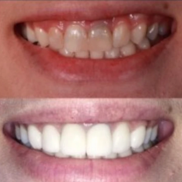 จัดฟันขอนแก่น, จัดฟันอุดรธานี, จัดฟันอุบลราชธานี รีวิว 15 จัดฟันขอนแก่น, จัดฟันอุดรธานี, จัดฟันอุบลราชธานี รีวิว 15