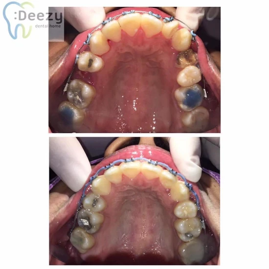 จัดฟันขอนแก่น, จัดฟันอุดรธานี, จัดฟันอุบลราชธานี รีวิว 1 จัดฟันขอนแก่น, จัดฟันอุดรธานี, จัดฟันอุบลราชธานี รีวิว 1