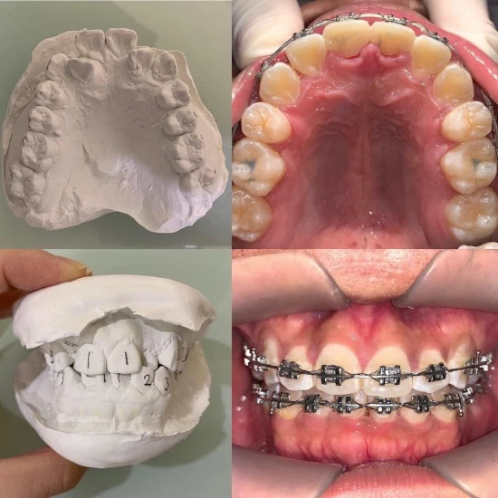 จัดฟันขอนแก่น, จัดฟันอุดรธานี, จัดฟันอุบลราชธานี รีวิว 4 จัดฟันขอนแก่น, จัดฟันอุดรธานี, จัดฟันอุบลราชธานี รีวิว 4
