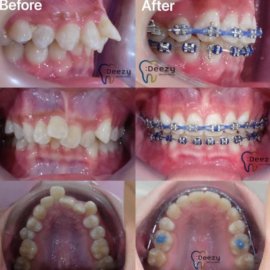 จัดฟันขอนแก่น, จัดฟันอุดรธานี, จัดฟันอุบลราชธานี รีวิว 6 จัดฟันขอนแก่น, จัดฟันอุดรธานี, จัดฟันอุบลราชธานี รีวิว 6