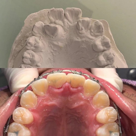 จัดฟันขอนแก่น, จัดฟันอุดรธานี, จัดฟันอุบลราชธานี รีวิว 8 จัดฟันขอนแก่น, จัดฟันอุดรธานี, จัดฟันอุบลราชธานี รีวิว 8