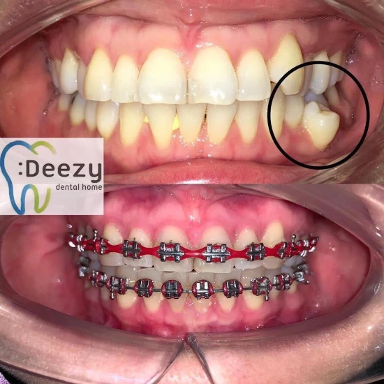 จัดฟันขอนแก่น, จัดฟันอุดรธานี, จัดฟันอุบลราชธานี รีวิว 9 จัดฟันขอนแก่น, จัดฟันอุดรธานี, จัดฟันอุบลราชธานี รีวิว 9