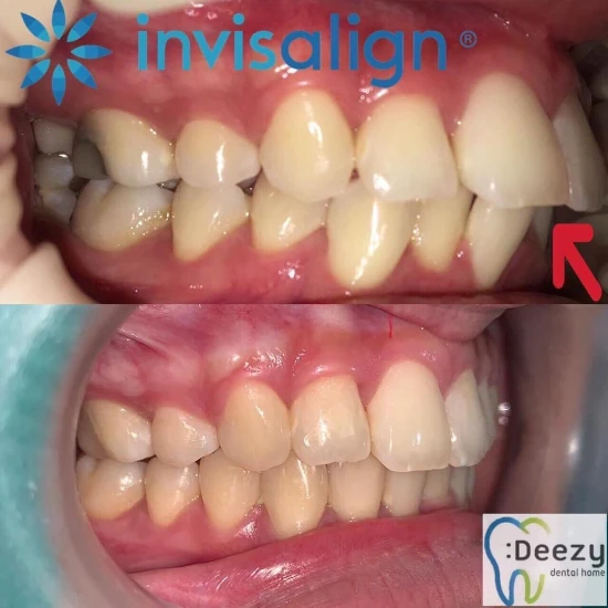 จัดฟันขอนแก่น, จัดฟันอุดรธานี, จัดฟันอุบลราชธานี รีวิว 11 จัดฟันขอนแก่น, จัดฟันอุดรธานี, จัดฟันอุบลราชธานี รีวิว 11