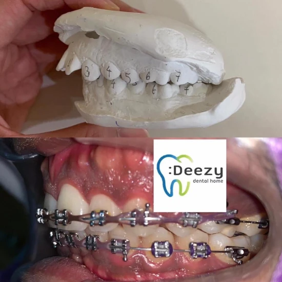 จัดฟันขอนแก่น, จัดฟันอุดรธานี, จัดฟันอุบลราชธานี รีวิว 12 จัดฟันขอนแก่น, จัดฟันอุดรธานี, จัดฟันอุบลราชธานี รีวิว 12