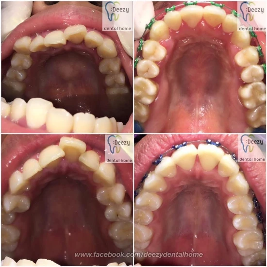 จัดฟันขอนแก่น, จัดฟันอุดรธานี, จัดฟันอุบลราชธานี รีวิว 13 จัดฟันขอนแก่น, จัดฟันอุดรธานี, จัดฟันอุบลราชธานี รีวิว 13