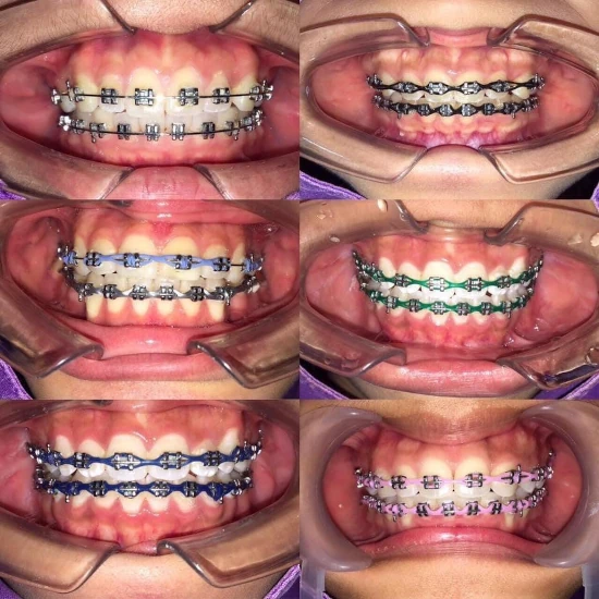 จัดฟันขอนแก่น, จัดฟันอุดรธานี, จัดฟันอุบลราชธานี รีวิว 14 จัดฟันขอนแก่น, จัดฟันอุดรธานี, จัดฟันอุบลราชธานี รีวิว 14