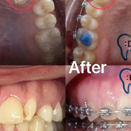 จัดฟันขอนแก่น, จัดฟันอุดรธานี, จัดฟันอุบลราชธานี รีวิว 15 จัดฟันขอนแก่น, จัดฟันอุดรธานี, จัดฟันอุบลราชธานี รีวิว 15