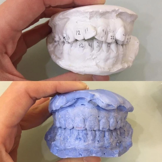 จัดฟันขอนแก่น, จัดฟันอุดรธานี, จัดฟันอุบลราชธานี รีวิว 18 จัดฟันขอนแก่น, จัดฟันอุดรธานี, จัดฟันอุบลราชธานี รีวิว 18