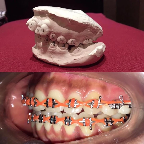 จัดฟันขอนแก่น, จัดฟันอุดรธานี, จัดฟันอุบลราชธานี รีวิว 20 จัดฟันขอนแก่น, จัดฟันอุดรธานี, จัดฟันอุบลราชธานี รีวิว 20