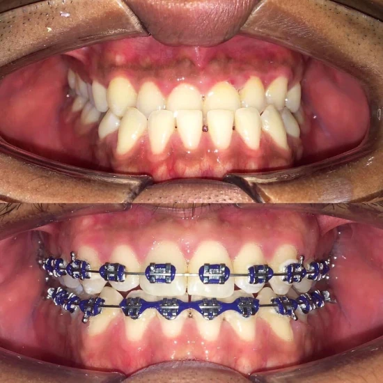 จัดฟันขอนแก่น, จัดฟันอุดรธานี, จัดฟันอุบลราชธานี รีวิว 21 จัดฟันขอนแก่น, จัดฟันอุดรธานี, จัดฟันอุบลราชธานี รีวิว 21