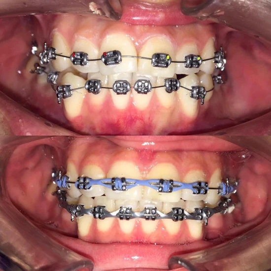 จัดฟันขอนแก่น, จัดฟันอุดรธานี, จัดฟันอุบลราชธานี รีวิว 23 จัดฟันขอนแก่น, จัดฟันอุดรธานี, จัดฟันอุบลราชธานี รีวิว 23