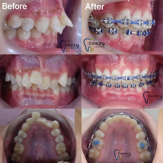จัดฟันขอนแก่น, จัดฟันอุดรธานี, จัดฟันอุบลราชธานี รีวิว 24 จัดฟันขอนแก่น, จัดฟันอุดรธานี, จัดฟันอุบลราชธานี รีวิว 24