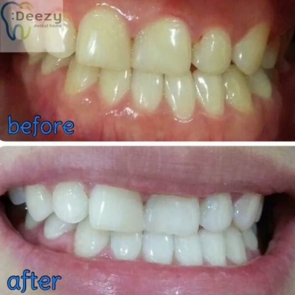 จัดฟันขอนแก่น, จัดฟันอุดรธานี, จัดฟันอุบลราชธานี รีวิว 1 จัดฟันขอนแก่น, จัดฟันอุดรธานี, จัดฟันอุบลราชธานี รีวิว 1