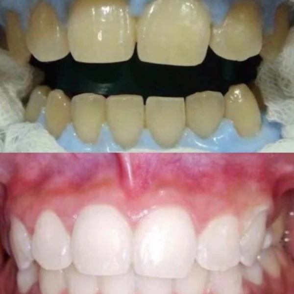 จัดฟันขอนแก่น, จัดฟันอุดรธานี, จัดฟันอุบลราชธานี รีวิว 4 จัดฟันขอนแก่น, จัดฟันอุดรธานี, จัดฟันอุบลราชธานี รีวิว 4